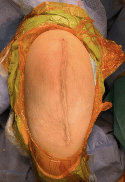 Zipper Suturing Improves Wound Recovery from Knee